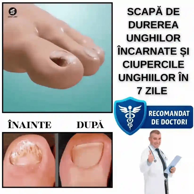 Plasture Unghii Încarnate - UnghiaFix™ 1+1 GRATIS